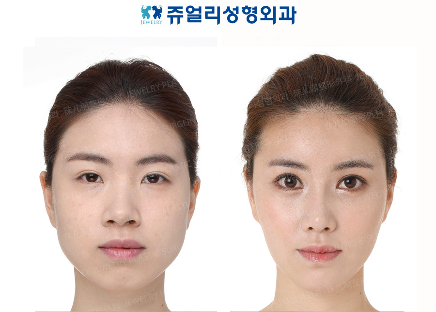 Eyes Surgery+Nose Surgery+Fat Grafting+Chin Implant+Chin Botox