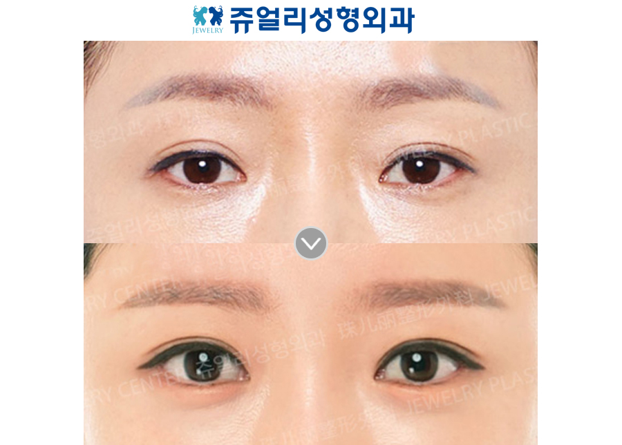 Incision Reoperation + Ptosis