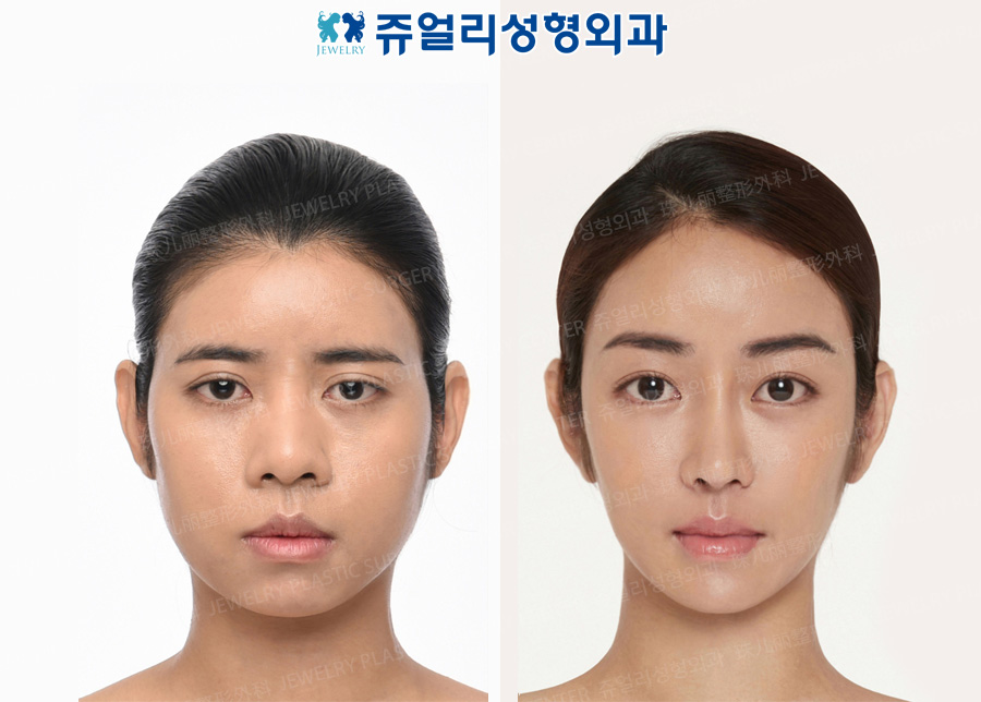 Double Eyelids (Ptosis), Dark Circle Removal, Nose(Wide Nose, Length Extend), Forehead Lifting, Fat Grafting, Cheekbone Reduction+Square Jaws Reduction+T-osteotomy