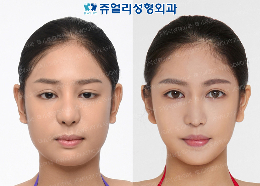 Nose Reoperation, Double Eyelids Reoperation (Ptosis), Cheek+Double Chin Liposuction, Square Jaw Reduction+T-osteotomy