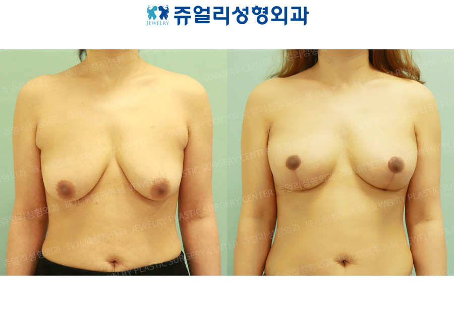 Breast Reduction + Lifting