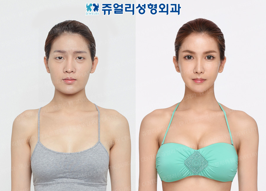 Breast Surgery