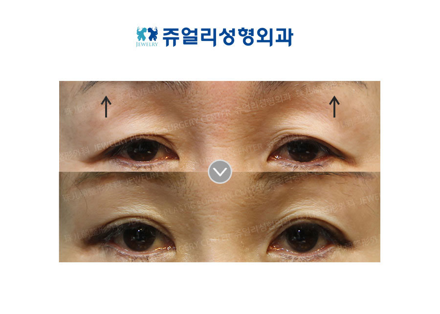 Brows Lifting
