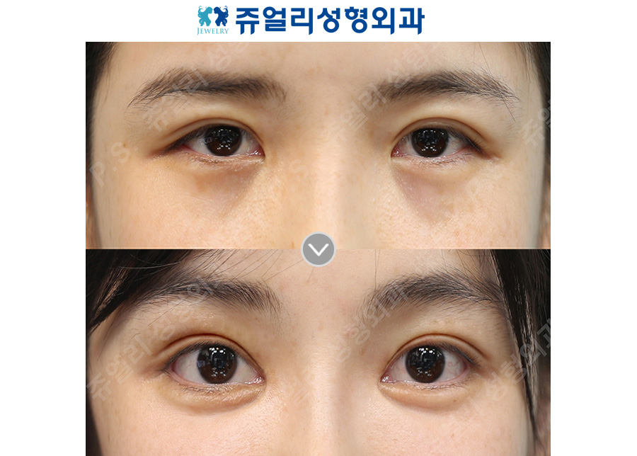 Double eyelid surgery (ptosis correction) + epicanthoplasty, lateral canthoplasty, lower canthoplasty + under-eye fat repositioning + aegyo-sal