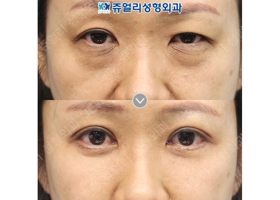 Upper blepharoplasty + lower blepharoplasty + midface lift