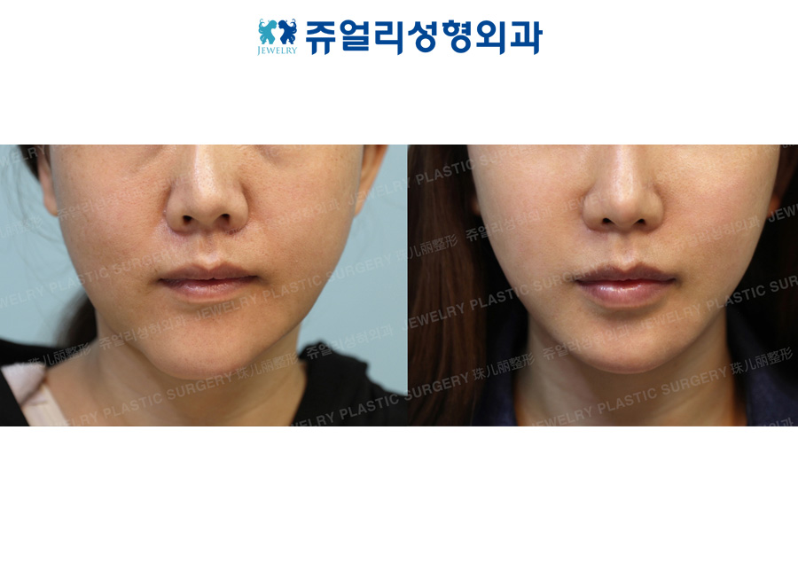 Front Chin Muscle Lifting + Fat Grafting+ Double Chin, Cheek Liposuction