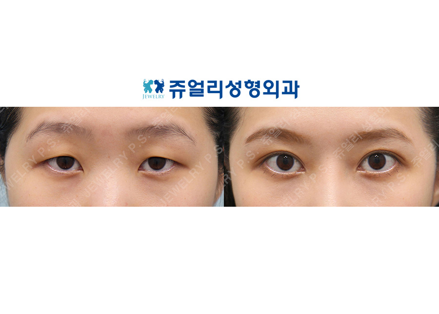 Double Eyelids (Eyes Enlargement)+Epicanthoplasty