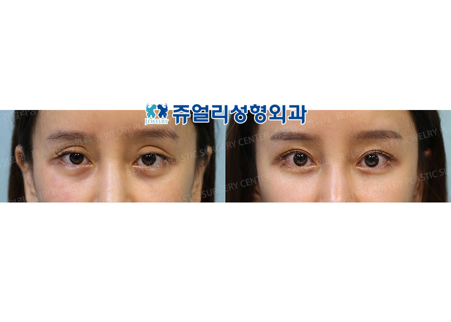 Double Eyelids Reoperation (Line Reduction) + Dark Circles (Loveband Removal & Fat-Repositioning Transconjunctival)