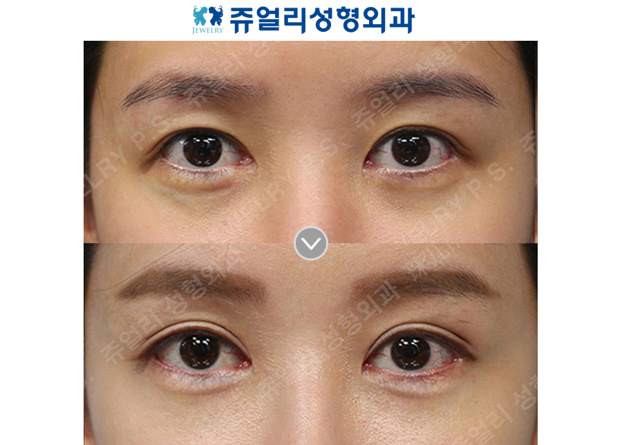 Double Eyelid Revision, Dark Circle Removal (Fat Repositioning)