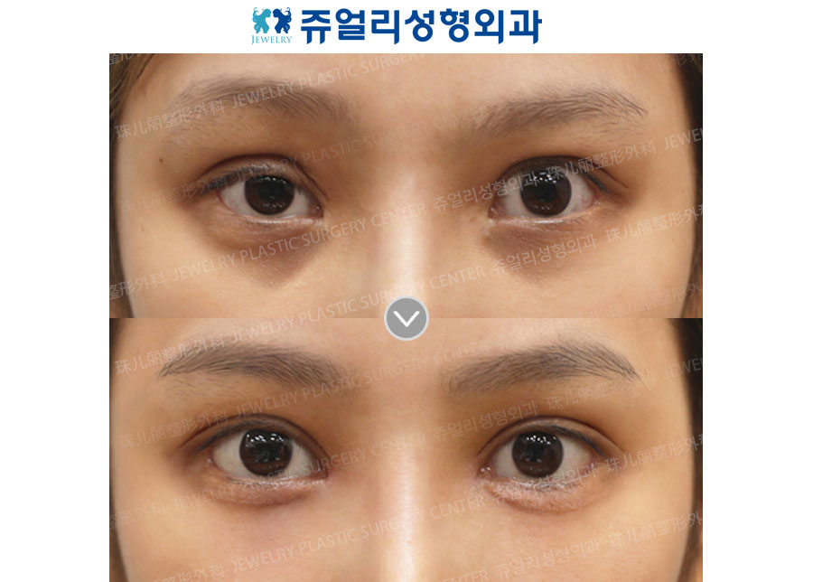 Eyes Reoperation, Ptosis, Dark Circle (+Loveband), Lower Lateral Canthoplasty