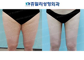 Thigh Liposuction