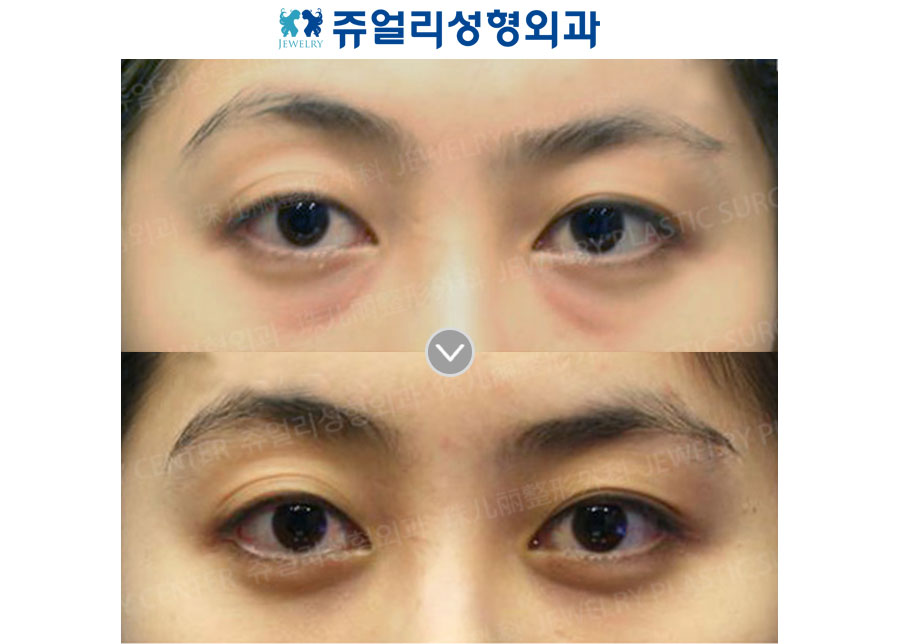 Fat-Repositioning Transconjunctival + Loveband