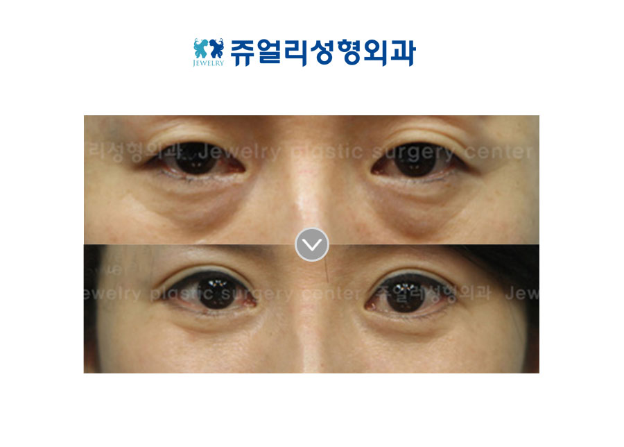 Upper/ Lower Blepharoplasty