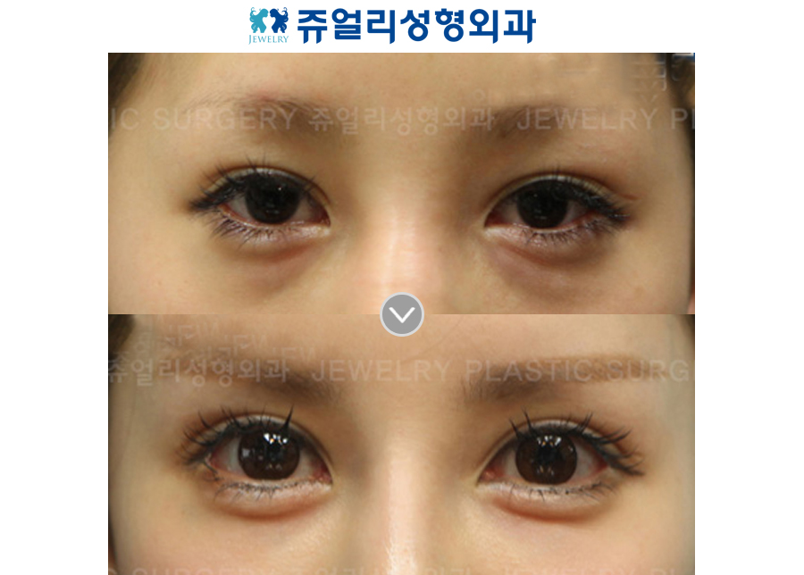 Double Eyelid Incision Reoperation + Ptosis+ Lower Blepharoplasty + Loveband