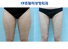 Thigh Liposuction