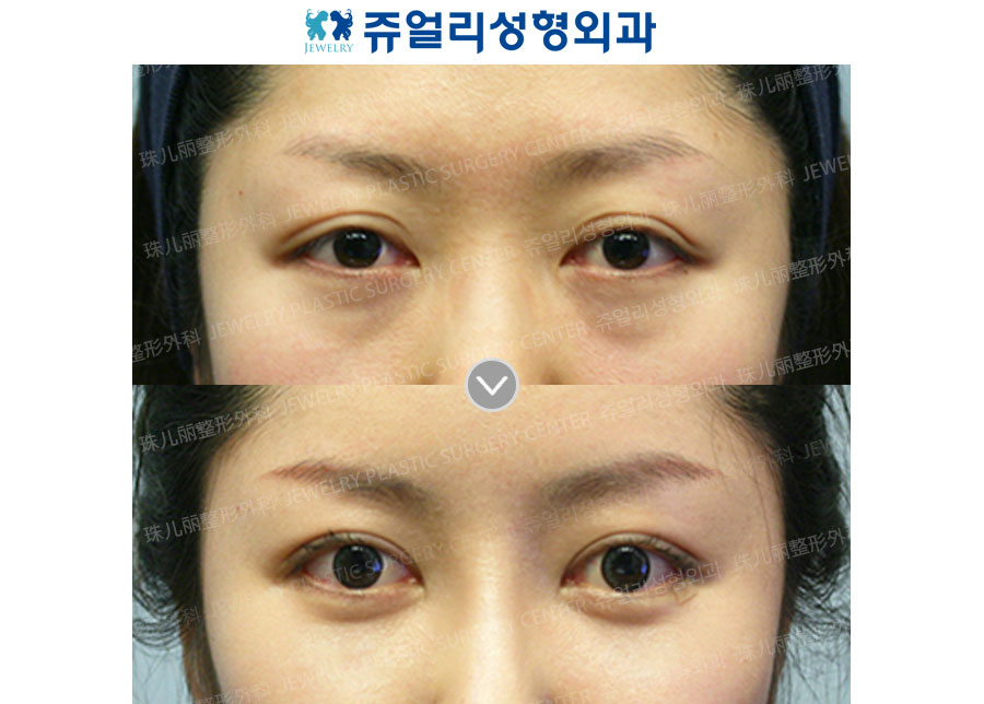 Double Eyelids + Dark Circle (Fat-Repositioning Transconjunctival)