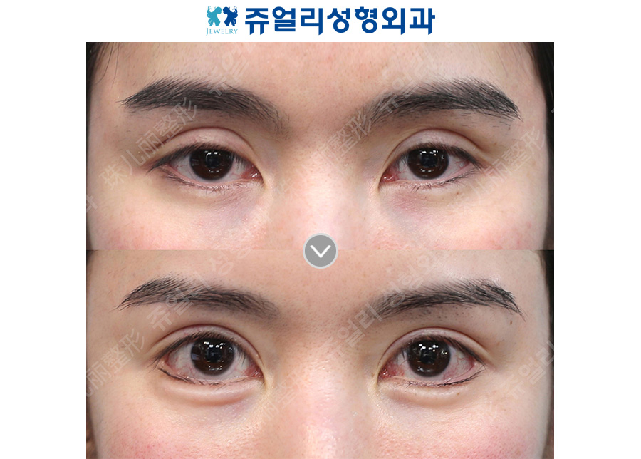 Revision double eyelid surgery (sausage eyelid correction, ptosis) + lateral and lower canthoplasty + under-eye fat repositioning + aegyo-sal