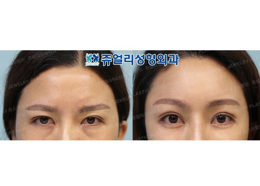 Forehead Lifting, Ptosis, Fat-Repositioning Transconjunctival Blepharoplasty, Nose Reoperation (Autogenous Costal Cartilage), Fat Grafting, Cheek & Chin Liposuction, Chin Muscles Lifting