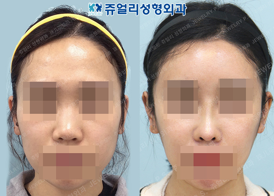 Rhinoplasty (Wide Nose Fix), Nostrils Reduction, Fat Grafting