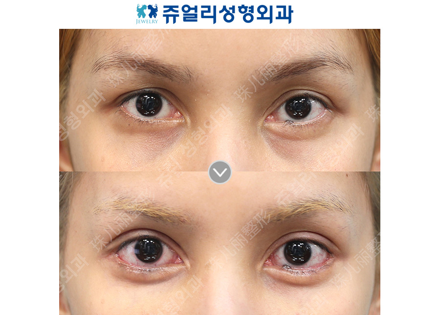 Double eyelid surgery (out-line) + lateral, lower canthoplasty + under-eye fat repositioning + aegyo-sal