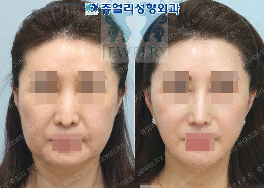 Rhinoplasty (Downturned Nose), Cheek/Jaw Liposuction, Facial Lifting/Neck Lifting