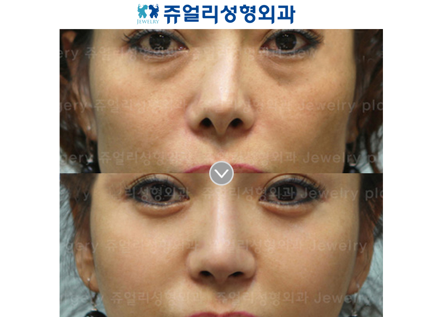 Lower Blepharoplasty