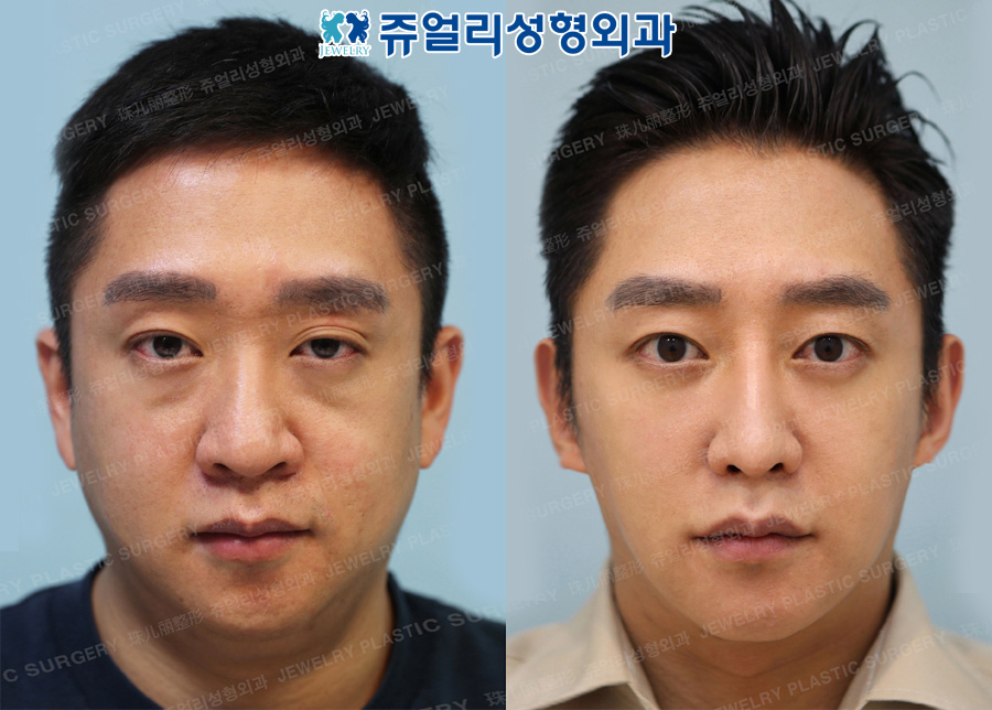 Non-Incision Ptosis Correction, Dark Circle, Nose+Nostrils Reduction, Double Chin Liposuction, Jaw Botox