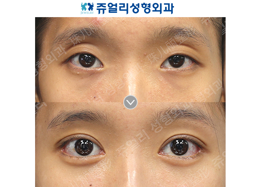 Double Eyelids (Ptosis Correction), Epicanthoplasty, Lateral Canthoplasty, Lower Lateral Canthoplasty, Under Eye Fat Repositioning (Dark Circle Eye Bag Removal, Loveband)