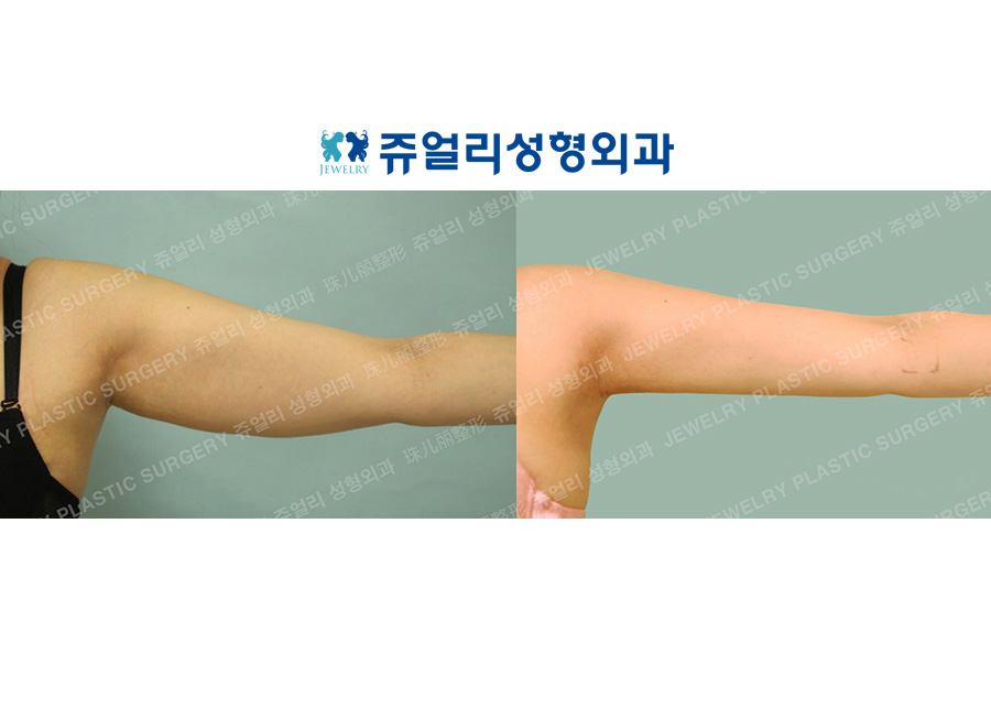 Arm Liposuction
