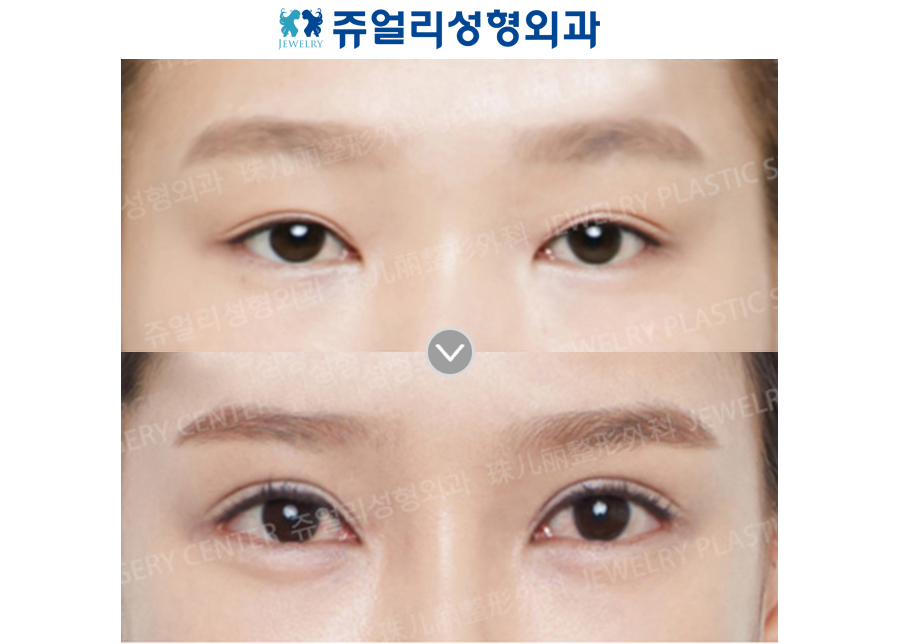 Ptosis Correction + Ptosis