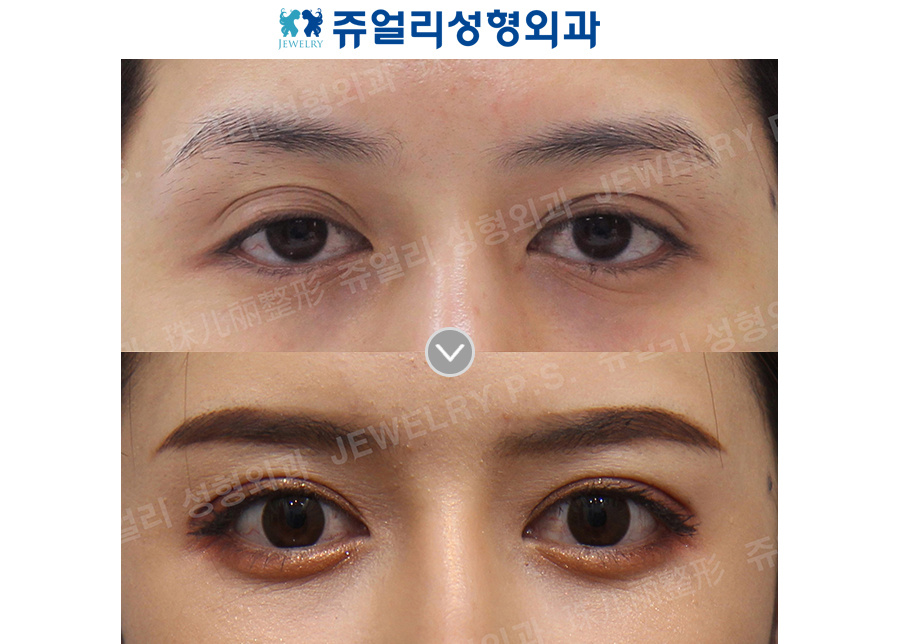 Ptosis correction (Eyes enlargement), Tranconjuctival Blepharoplasty+Loveband