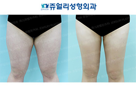 Thigh Liposuction