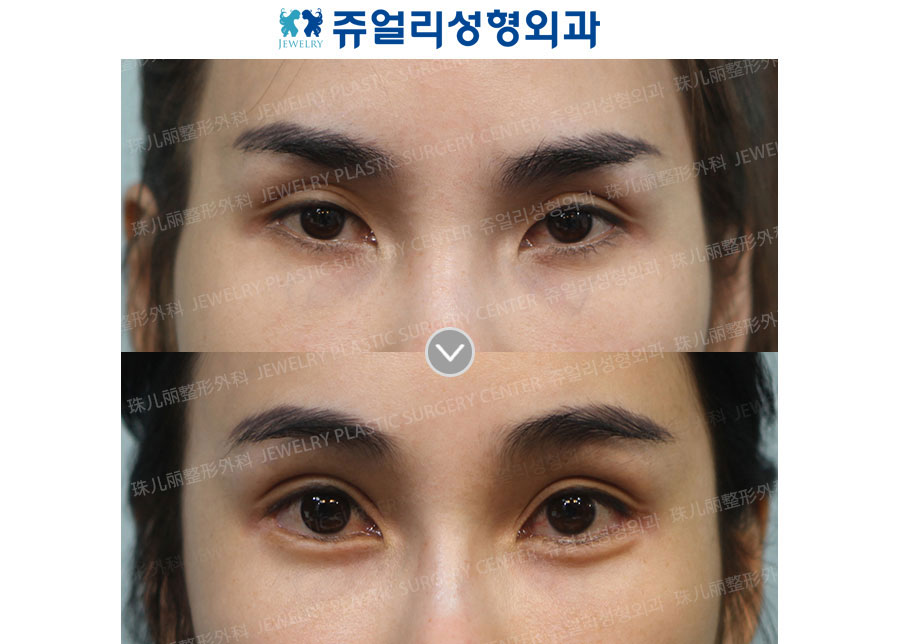 Ptosis + Lower Lateral Canthoplasty