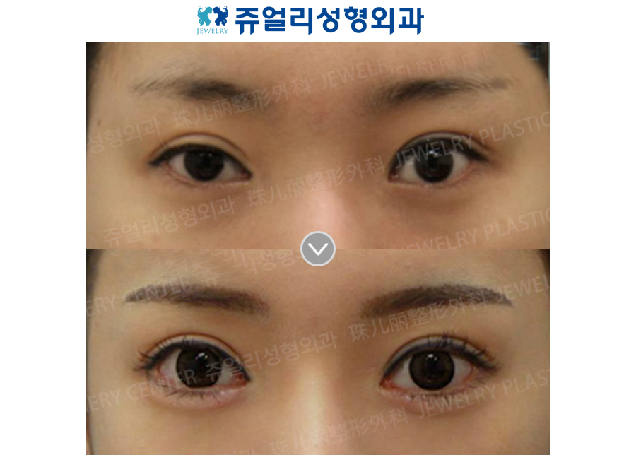 Incision Reoperation + Ptosis