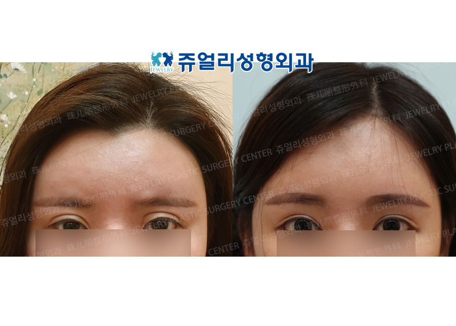 Forehead Lifting + Eyes Reoperation + Epicanthoplasty+Lateral Canthoplasty + Lower Lateral Canthoplasty + Dark Circle Removal + Philtrum Reduction +  Lips Corner Lift (Reoperation)