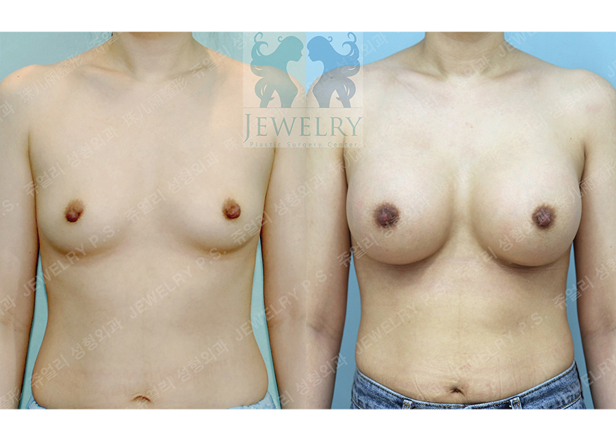 Breast Augmentation (Under Breast Incision, 425cc left right)