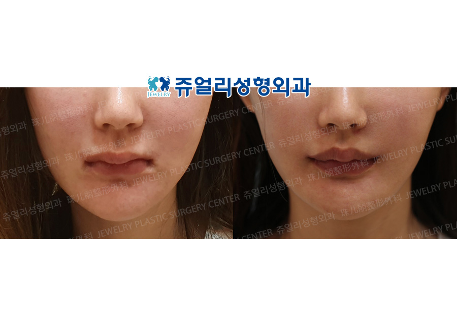 Philtrum Reduction +  Lips Corner Lift (Reoperation)