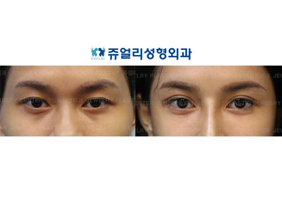 Non-Incision, Lateral Canthoplasty + Lower Lateral Canthoplasty+ Fat-Repositioning Transconjunctival Blepharoplasty