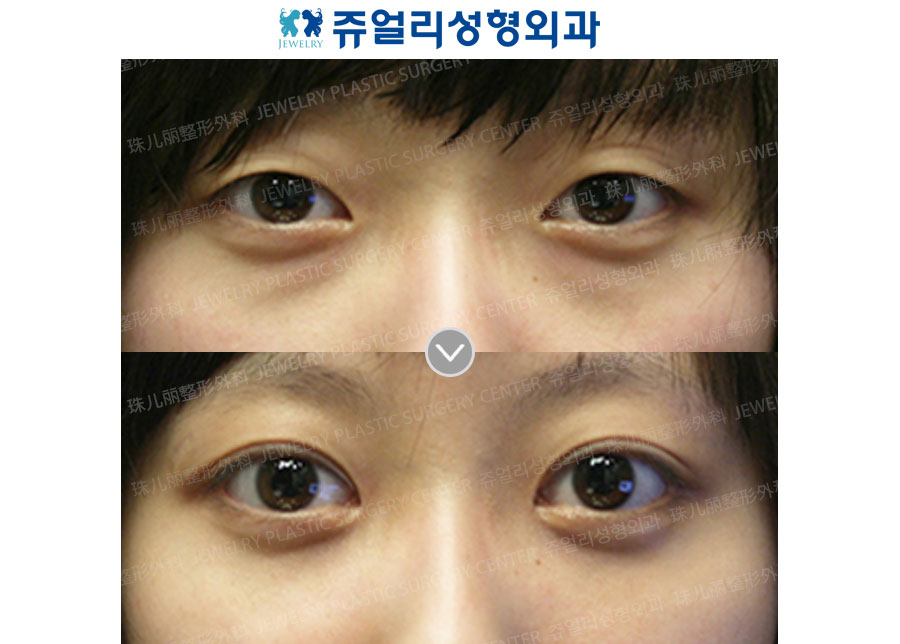 Double Eyelids + Dark Circle (Fat-Repositioning Transconjunctival)