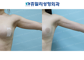 Arm Liposuction