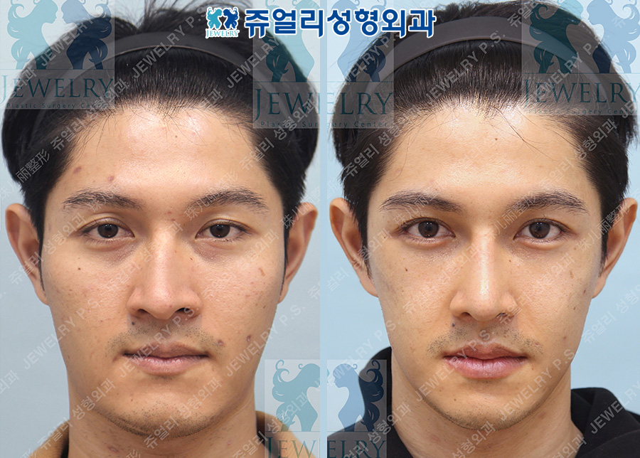 Eye surgery (natural double eyelid), lower canthoplasty/outer eye corner, under-eye fat repositioning + aegyo-sal, rhinoplasty, fat grafting, cheek and chin liposuction, zygoma + square jaw + T-osteotomy + male plastic surgery