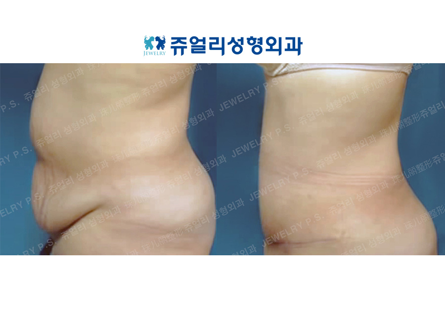 Liposuction (Abdomen Lifting)