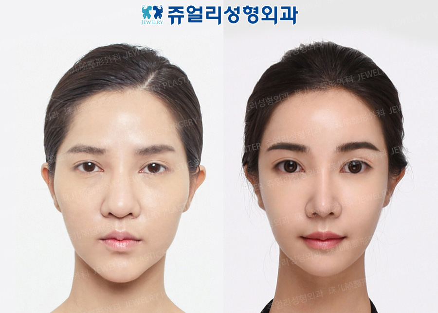 Non-Incision, Fat-Repositioning Transconjunctival Blepharoplasty, Nose, Chin Lifting, Fat Grafting, Cheek/Chin Liposuction, Cheekbone Reduction, Breast Reoperation