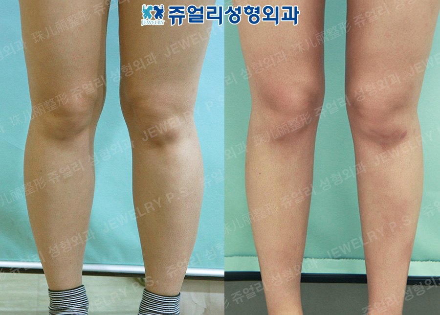 Calf Size Reduction High-Frequency (Nerve Block)