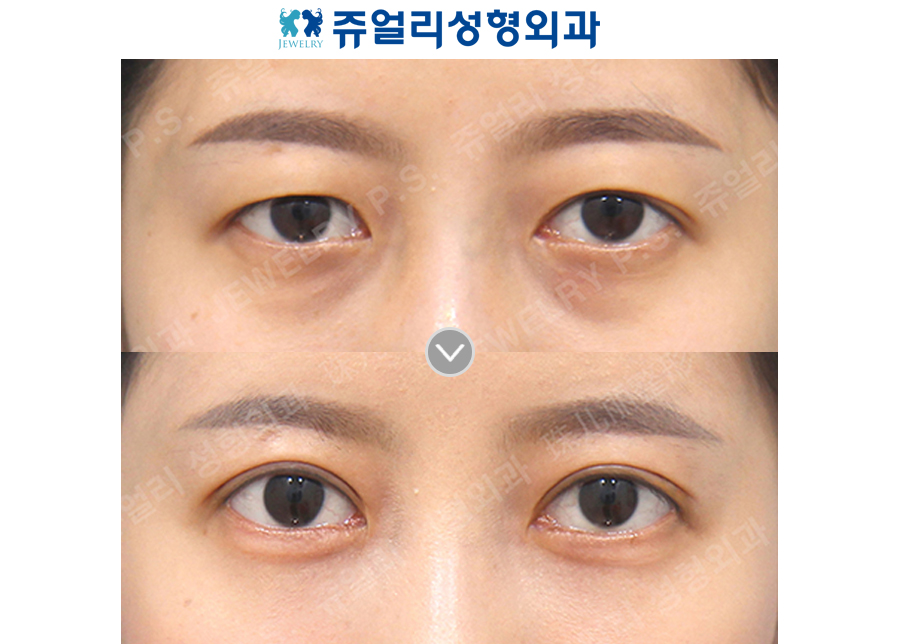 Double Eyelid (Incision), Dark Circles (Under Eye Fat Repositioning)+Loveband