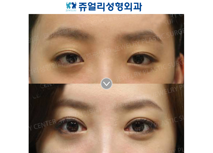 Double Eyelids Non-Incision