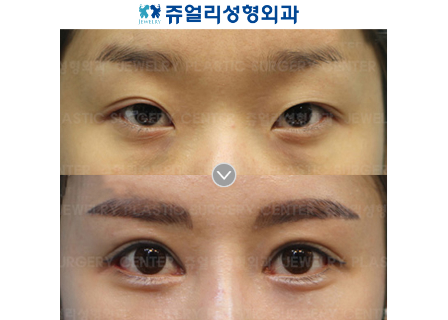 Incision Reoperation + Ptosis