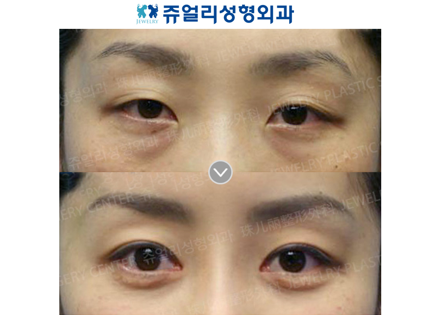 Double Eyelids Non-Incision