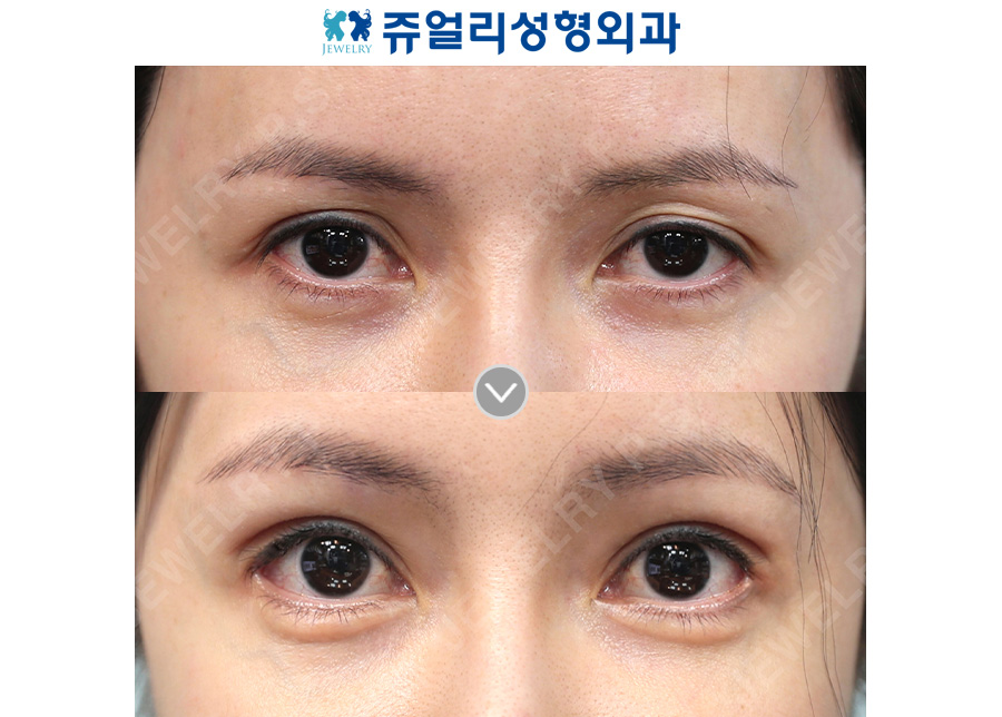 Double eyelid surgery (ptosis + ptosis correction) + under-eye fat repositioning + aegyo-sal