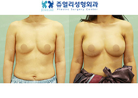 Breast Augmentation